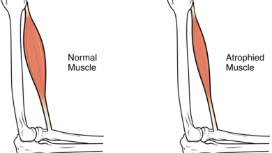 שריר מנוון לעומת שריר נורמלי